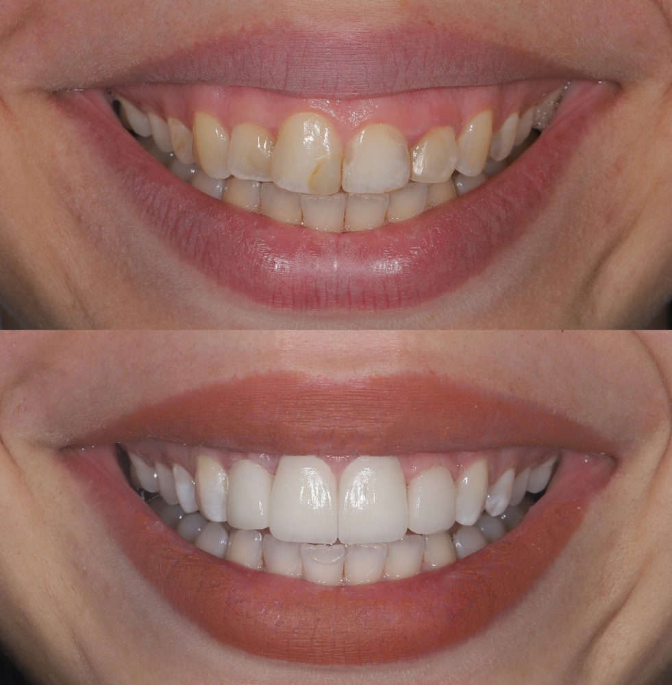 dental veneer replacement
